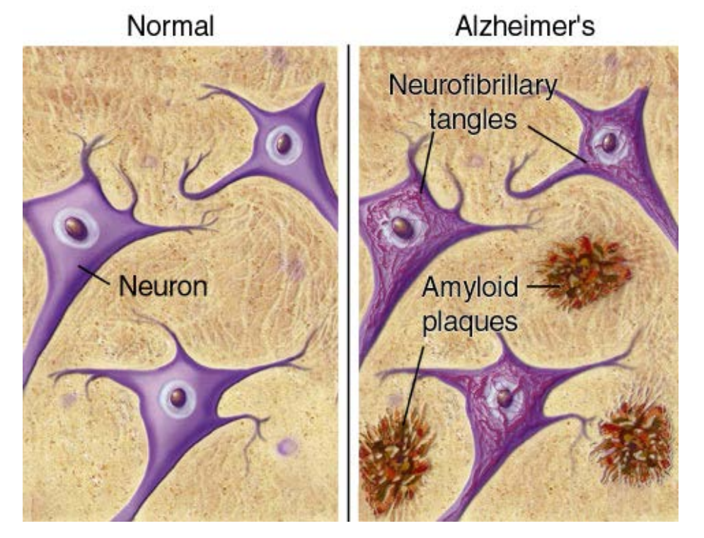 Болезнь Альцгеймера амилоидные бляшки. Болезнь Альцгеймера бета амилоид. Амилоид в нейронах. Нейрофибриллярные клубки.
